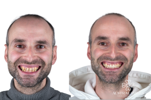 Dental Crowns
