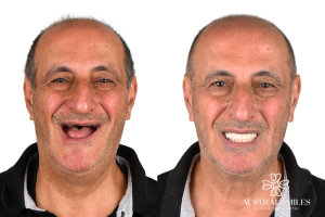 Dental Implants