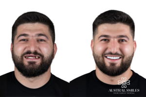 Dental Implants