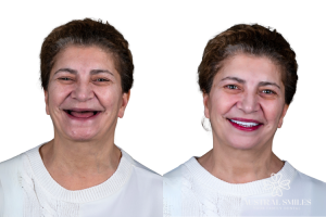 Dental Implants