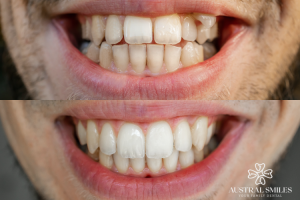 Invisalign