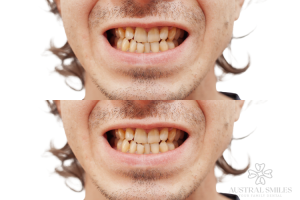 Invisalign