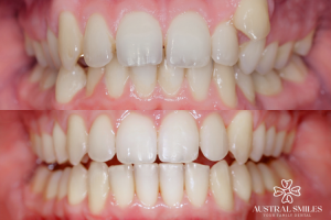 Invisalign