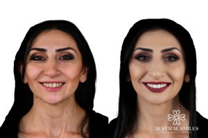 Veneers
