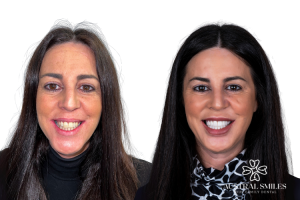 Veneers