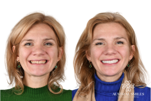 Veneers