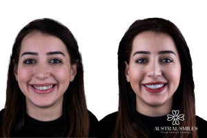 Veneers