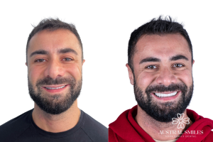 Veneers