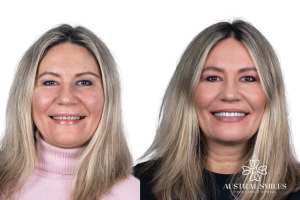 Veneers