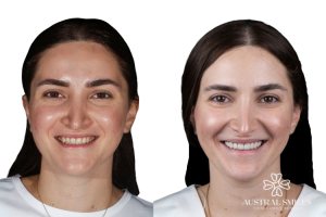 Veneers