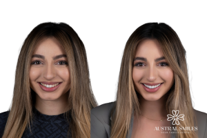 Veneers