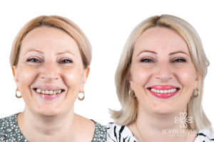 Veneers