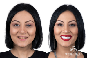 Veneers