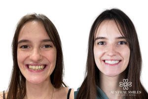 Veneers