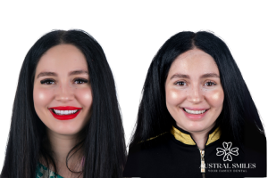 Veneers