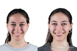 Veneers
