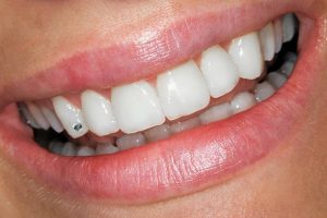 Beautiful Smile With Circon